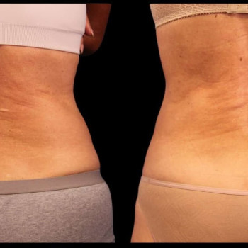 Кріоліполіз бока (спина)