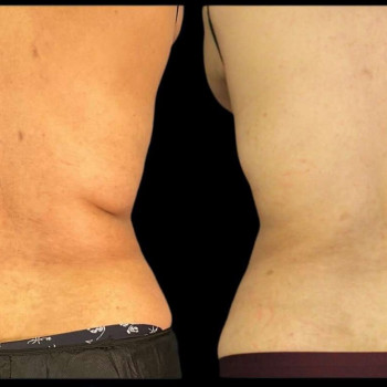 Кріоліполіз бока (спина)