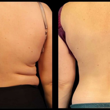 Кріоліполіз бока (спина)
