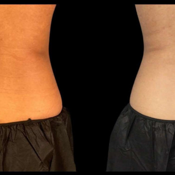 Кріоліполіз бока (спина)