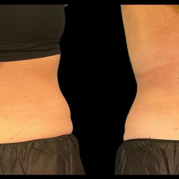 Кріоліполіз бока (спина)