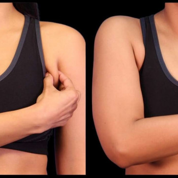 Кріоліполіз рук