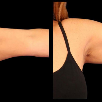 Кріоліполіз рук