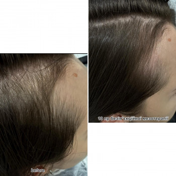 безінєкційна мезотерапія