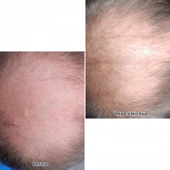 безінєкційна мезотерапія