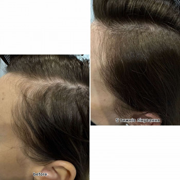 безінєкційна мезотерапія