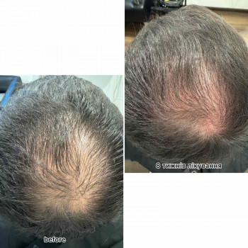 безінєкційна мезотерапія