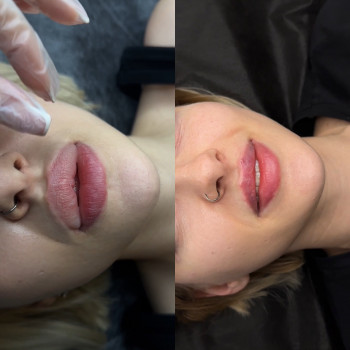 Перероблення губ. Виведення старого філеру та зроблена нова естетична гарна форма губ