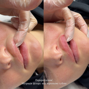 Виведення міграції філера