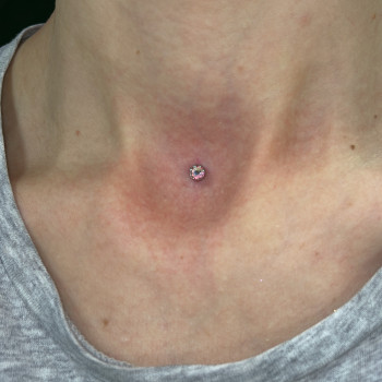 Мікродермал