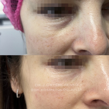 Корекція носослізноі борозди double технікою