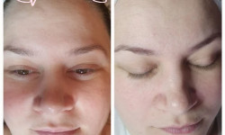 Фракційна мезотерапія VITAMIN COMPLEX Косметолог-эстетист Светлана Харьков