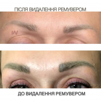 Видалення ремувером