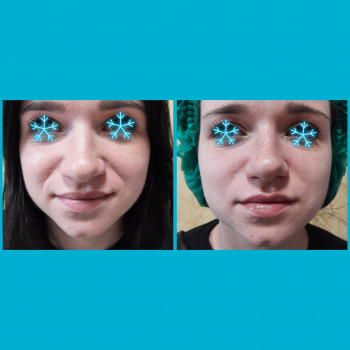  
Коррекция носогубных складок
До и через 30 мин после