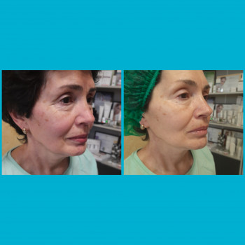  
 
До и после smas