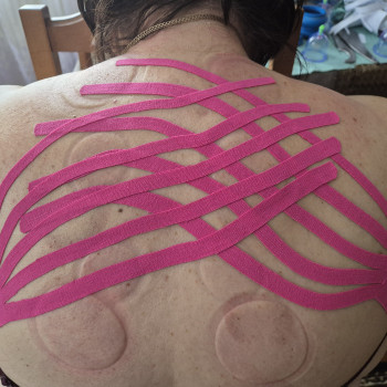 Лімфодренажне тейпуіання холки