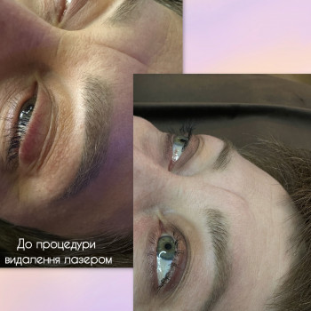 Видалення лазером
                    Майстер перманентного макіяжу Oksana Луцьк