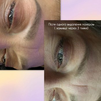 Видалення лазером
                    Майстер перманентного макіяжу Oksana Луцьк