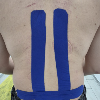 Тейпування м'язів поясниці, для зняття напруги та фіксації