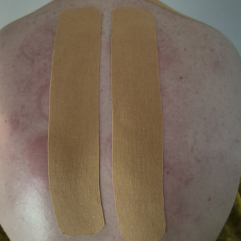 Тейпування для зняття напруги з м'язів