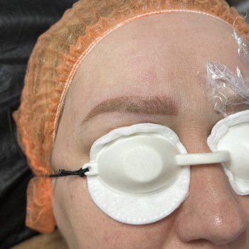 Після видалення темного пігменту