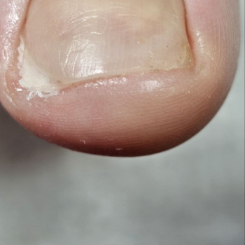 Протезування нігтя для відновлення його цілісності