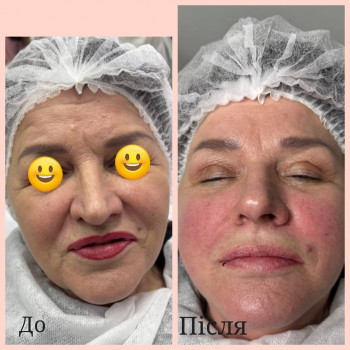 Зроблено заповнення носогубних заломів, кісетних зморшок та міжбрів'я, підняття куточків губ