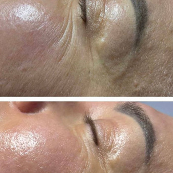 результат процедури RF ліфтінг