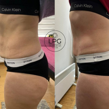 результат процедури RF ліфтінг та кавітації