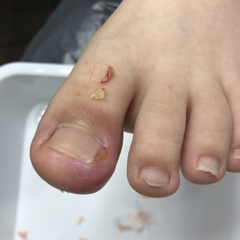 Видалення куточків врослого нігтя. 
Безболісна процедура!