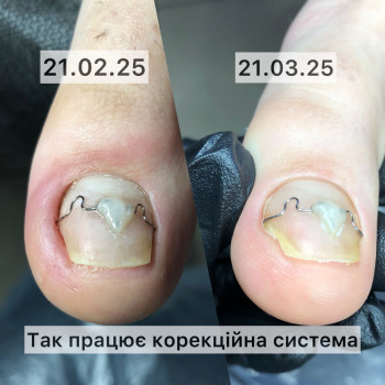 Корекційна система скоба 3ТО. Вирішує проблему з деформаціє