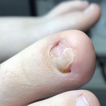 Зачистка травмованого нігтя. Без болю!