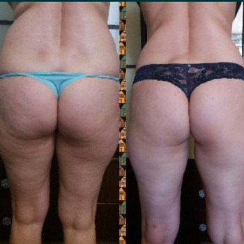 Антицилюлітний вакуумний масаж
                    Косметолог-эстетист Юлия Киев