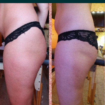 Антицилюлітний вакуумний масаж
                    Косметолог-эстетист Юлия Киев