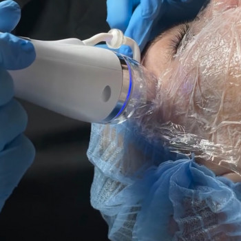 Мікроголковий RF ліфтинг