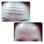 Ботулінотерапія Косметолог-ін'єкціоніст Юлия Кропивницький