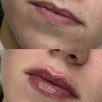 Збільшення губ
                    Косметолог-инъекционист Віталія Ивано-Франковск