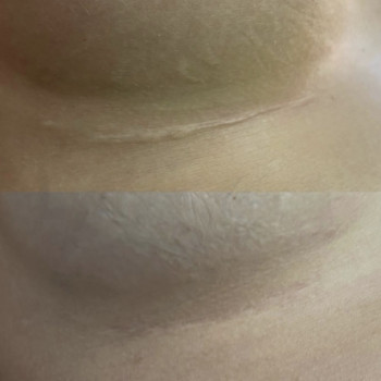 Удаление шрама