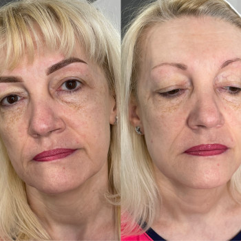 Одразу після процедури по загоєнню будуть світліші