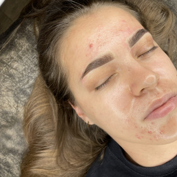 Одразу після процедури