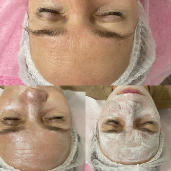 Химические пилинги
                    Косметолог-ін'єкціоніст Ирина Херсон