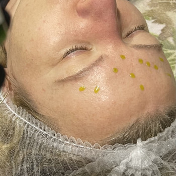 Химические пилинги
                    Косметолог-ін'єкціоніст Ирина Херсон