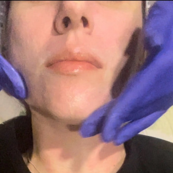 Биоревитализация Пилингами
                    Косметолог-ін'єкціоніст Ирина Херсон