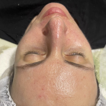 Биоревитализация Пилингами
                    Косметолог-ін'єкціоніст Ирина Херсон