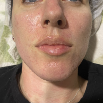 Биоревитализация Пилингами
                    Косметолог-ін'єкціоніст Ирина Херсон