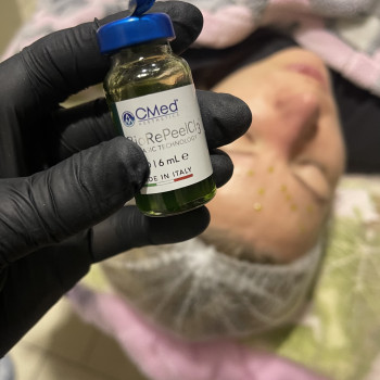 Биоревитализация Пилингами
                    Косметолог-ін'єкціоніст Ирина Херсон
