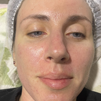 Жёлтый (ретиноловый) пилинг
                    Косметолог-инъекционист Ирина Херсон