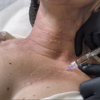 Биоревитализация шеи и декольте
                    Косметолог-ін'єкціоніст Ирина Херсон