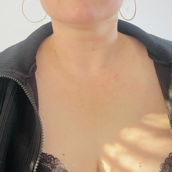 Биоревитализация шеи и декольте
                    Косметолог-ін'єкціоніст Ирина Херсон