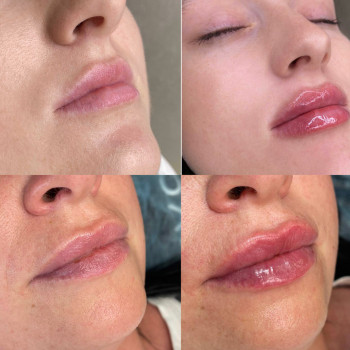 Аугументация губ
                    Косметолог-ін'єкціоніст Ирина Херсон